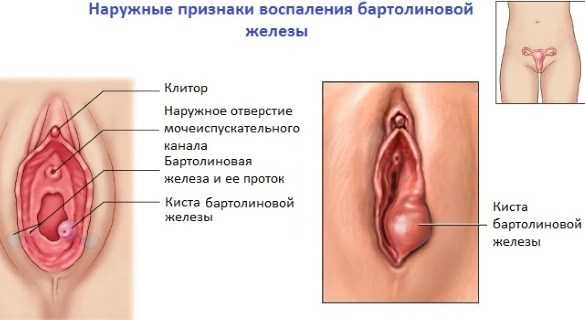 Бартолинит - симптомы, причины, диагностика, методы лечения