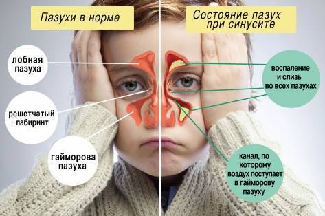 Гайморит у беременных: лечение и последствия