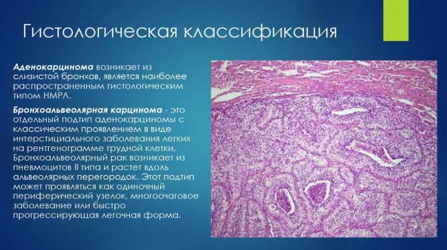 Классификация рака легкого