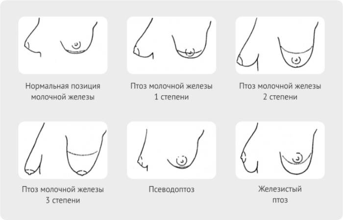 Обвисла грудь. что делать?