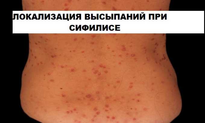 Полькортолон тс