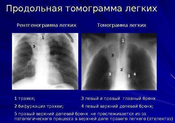 Единичные очаги в лёгком