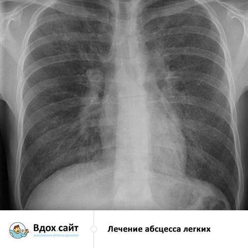 Гнойная пневмония: симптомы, лечение и последствия