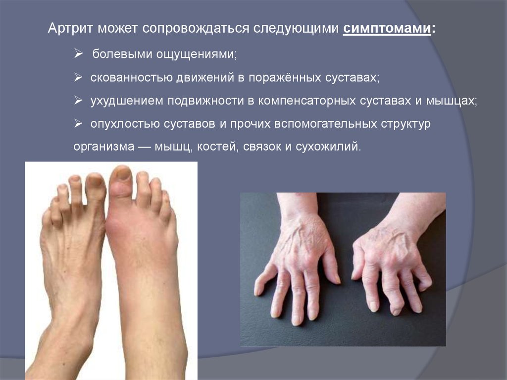 Ревматоидный артрит
