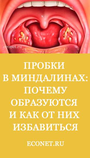 Как вылечить хронический тонзиллит раз и навсегда