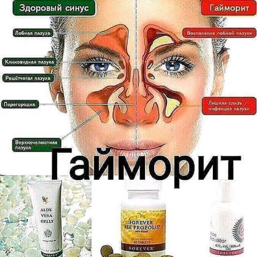 Как можно вылечить гайморит дома?