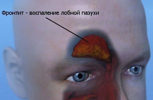 Фронтит — симптомы и лечение у взрослых