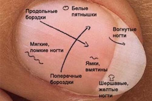 Причины инфаркта миокарда: причины возникновения и предрасполагающие факторы