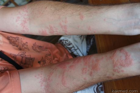 Укус медузы: последствия и что делать при укусе медузы.