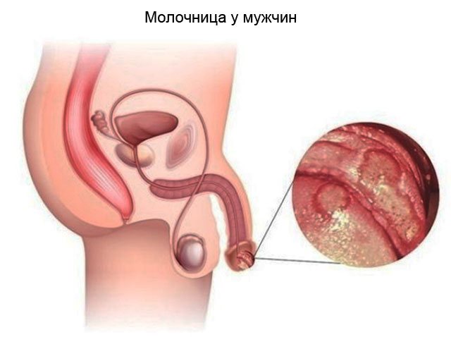 Лечение паховой эпидермофитии у мужчин и женщин