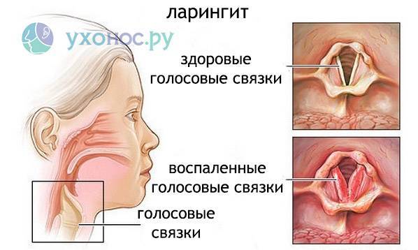 Атрофический фарингит: симптомы и современное лечение