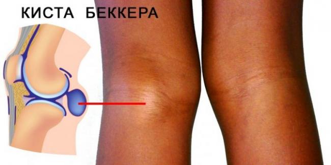 Появление шишек на теле