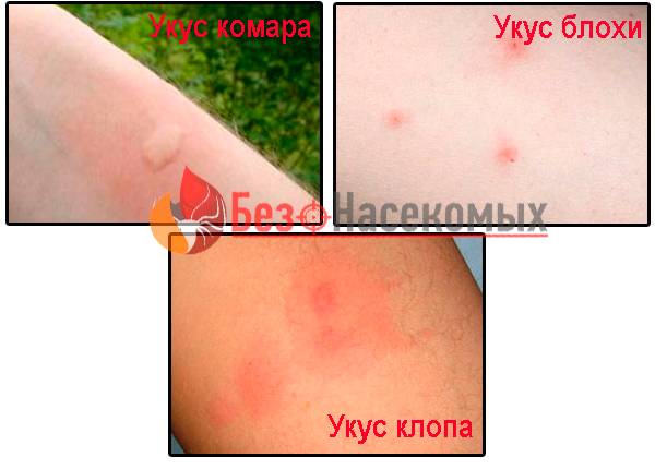 В чём опасность укусов клопов? как лечить последствия укусов?