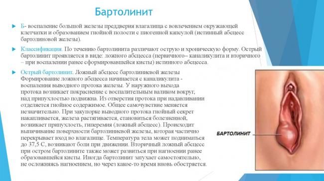 Бартолиновая железа – что такое, где находится? киста, воспаление бартолиновой железы (бартолинит у женщин)
