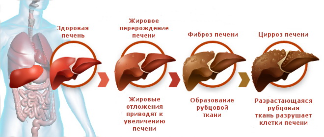 Что нельзя есть при гепатите