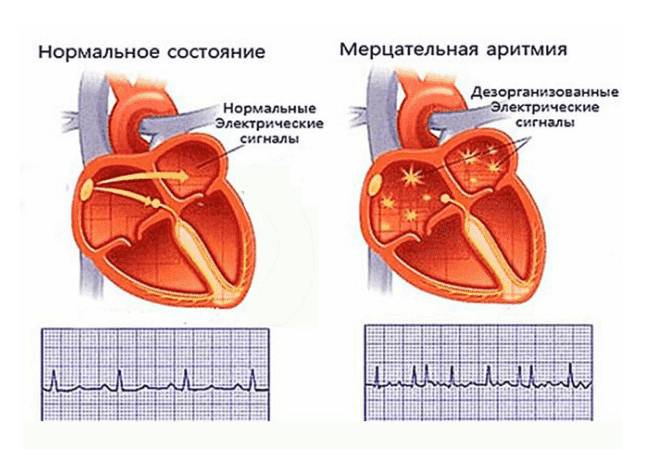 Питание при аритмии
