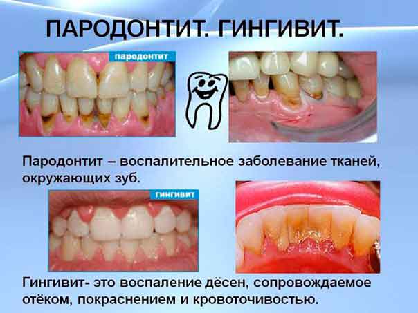 Кровоточат десны: в чем причина и как быстро себе помочь