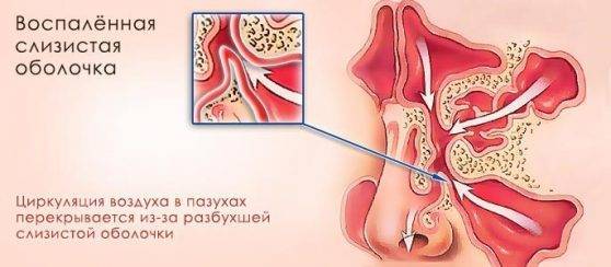 Фронтит