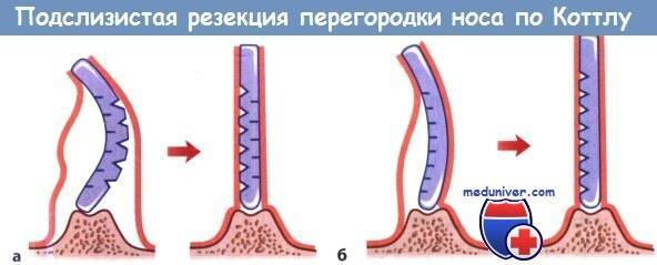 Мкб 10 врожденная перфорация носовой перегородки