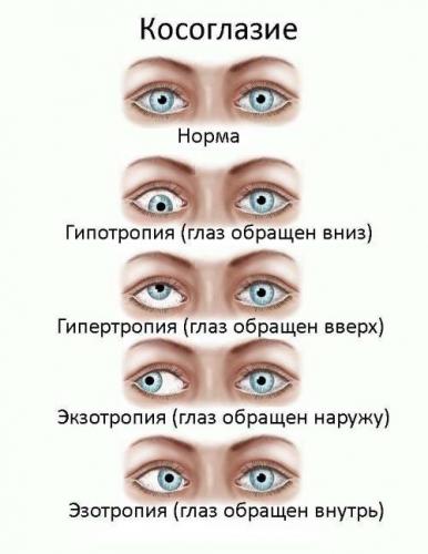Расходящееся косоглазие: причины, симптомы и лечение экзотропии