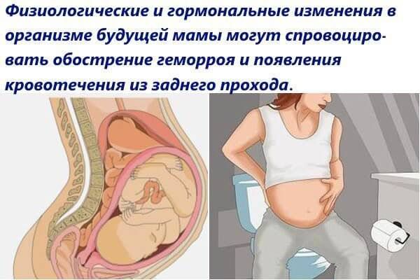Геморрой