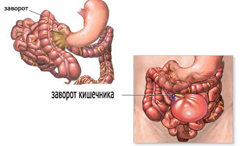 Заворот кишок - симптомы у взрослых и детей, причины и лечение | здрав-лаб