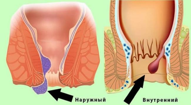 Что нужно знать о геморрое любому человеку?