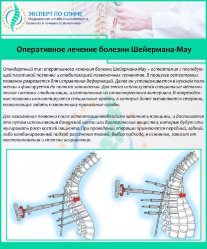 Искривление позвоночника (болезнь шейермана-мау )