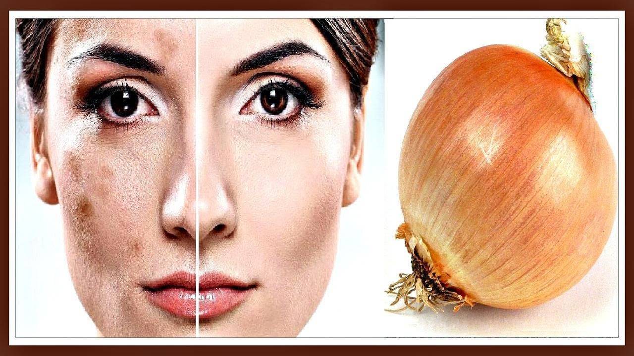 Как луком лечить насморк?