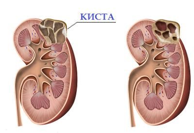 Лечение кисты на почке безоперационными методами