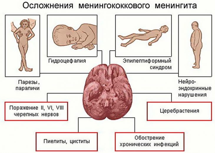 Симптомы, лечение, профилактика менингококковой инфекции