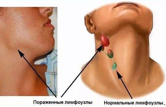 Как лечить лимфоузел под ухом болит
