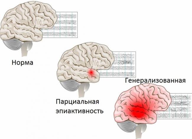 Абсанс