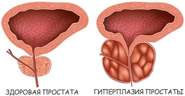 Характеристика препарата урорек и его применение