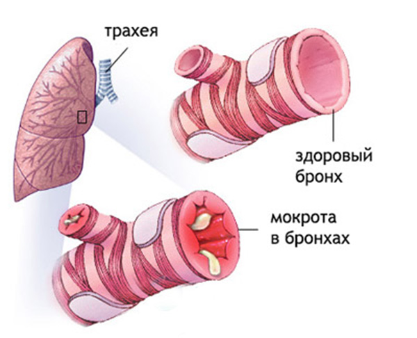 Суприма-бронхо: отзывы