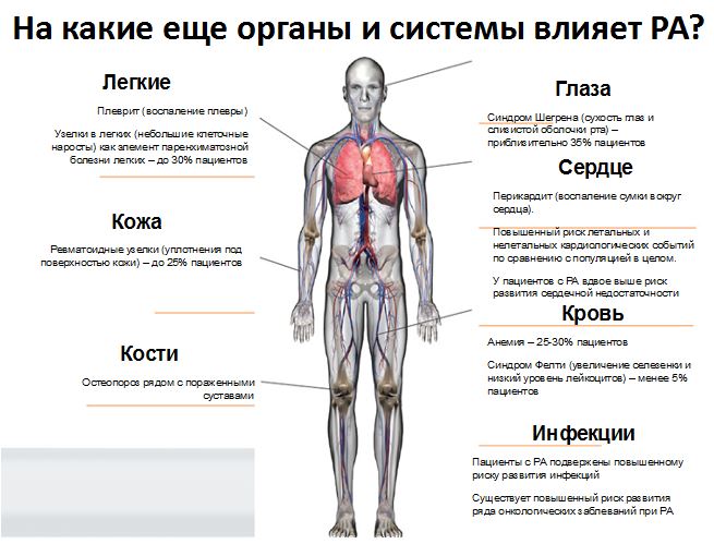 Ревматоидный артрит – симптомы, диагностика и лечение серонегативного, серопозитивного видов артрита