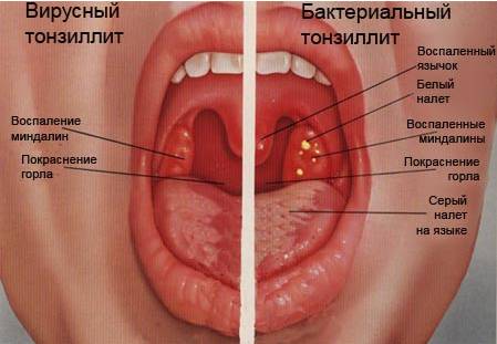 Сходства и отличия ларингита и фарингита