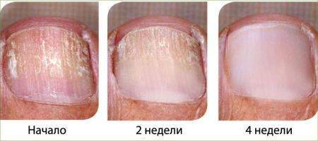 Противогрибковое средство Фармстандарт-Лексредства Микодерил Раствор - отзывы