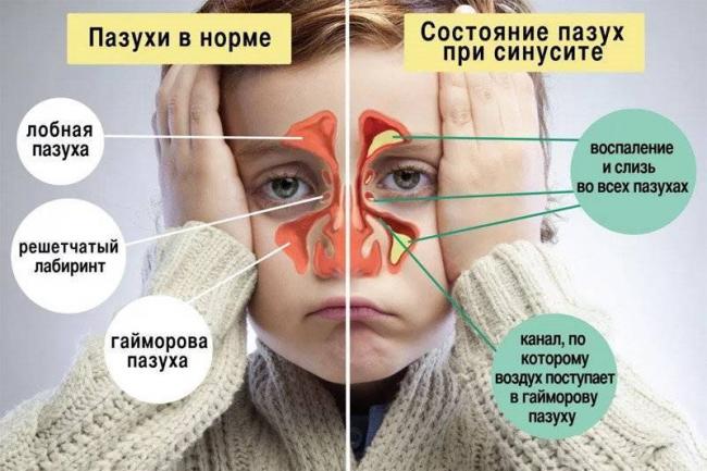 Выделения из носа: о чем говорят, связь с болезнями, что делать