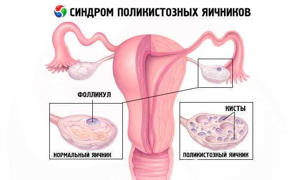 Что такое синдром поликистозных яичников или спкя?