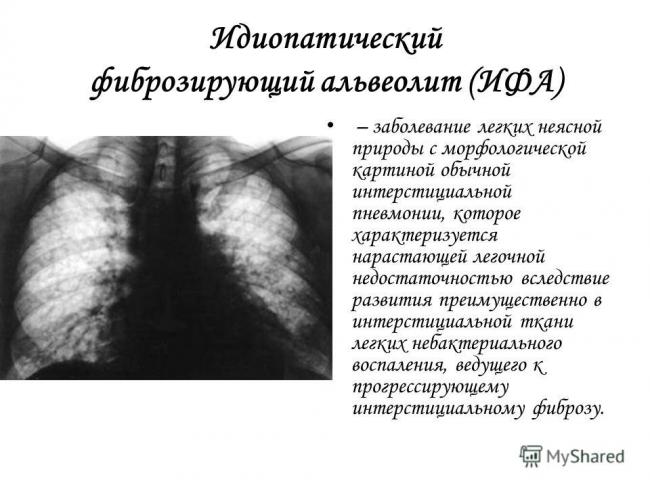 Симптомы фиброзирующего альвеолита и признаки болезни