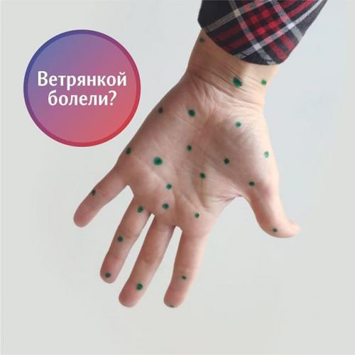 Ветрянкой можно и не болеть – вакцина окавакс