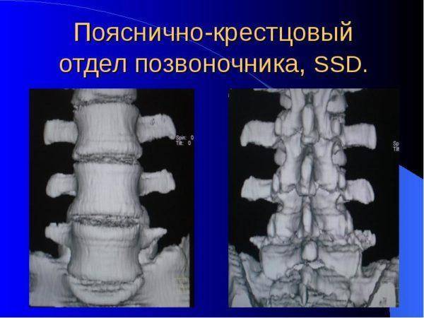 Бандаж для позвоночника: поясничный отдел