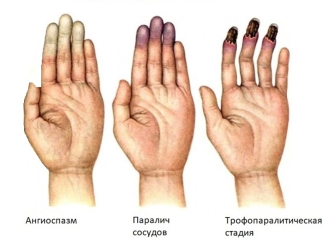 Синдром рейно причины лечение