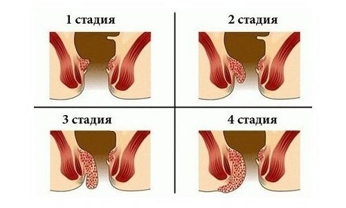 Средства длечения геморроя Novartis Прокто-гливенол свечи - отзывы