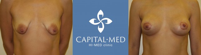 Птоз груди после лактации и кормления | mybreast.ru