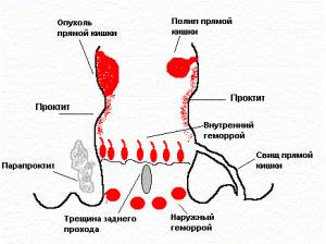Что делать если попа чешется