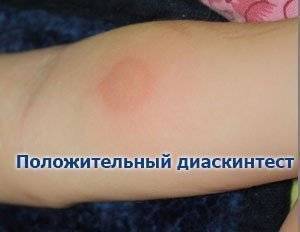 Положительный результат диаскинтеста: фото, причины, что делать?