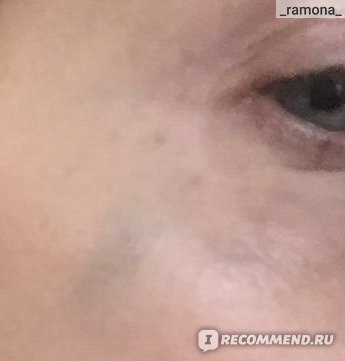 «уколы красоты»: инъекции диспорта