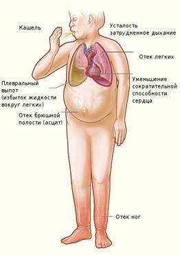 Симптомы и лечение кашля при сердечной недостаточности